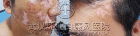 白癜风症状
